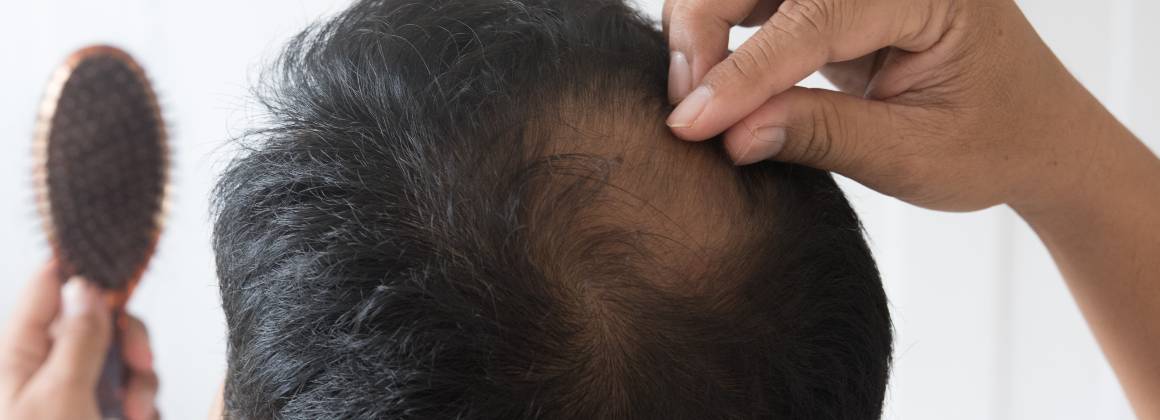 Vad orsakar tunnhårighet och håravfall?