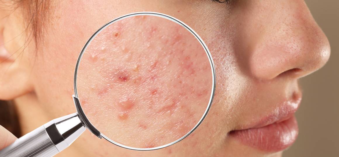 Varför är det så svårt att bli av med acne?