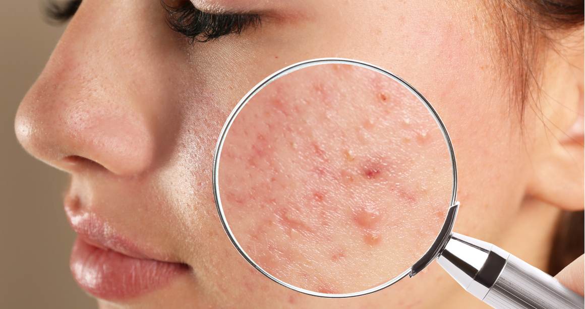 Vad är skillnaden mellan finnar och acne?
