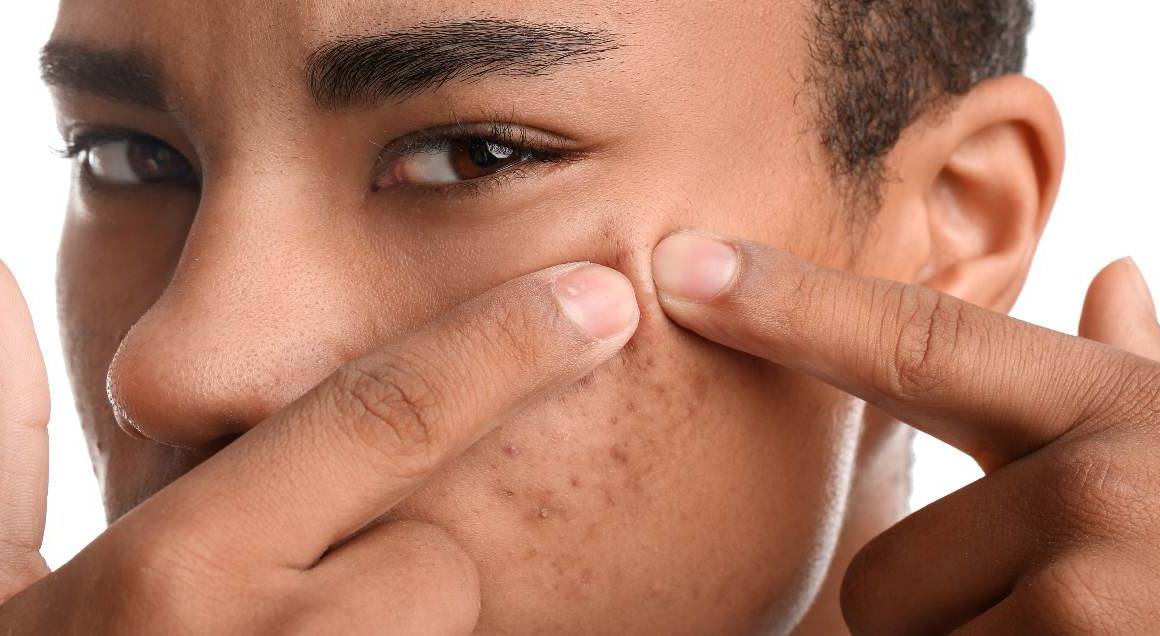 Hur man åtgärdar hormonell acne