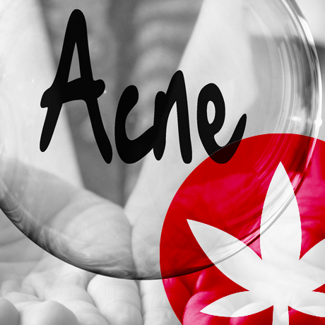 Hur kan CBD hjälpa till i kampen mot akne?