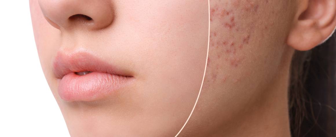 Vad är skillnaden mellan acne och finnar?
