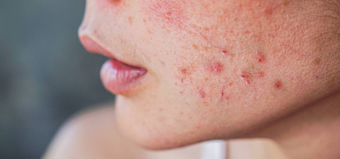 Hur blir dermatologer av med acne?