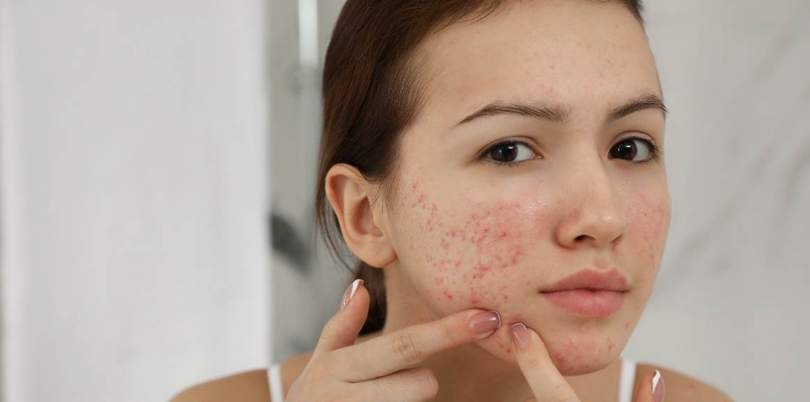 Vid vilken ålder slutar vuxen acne?