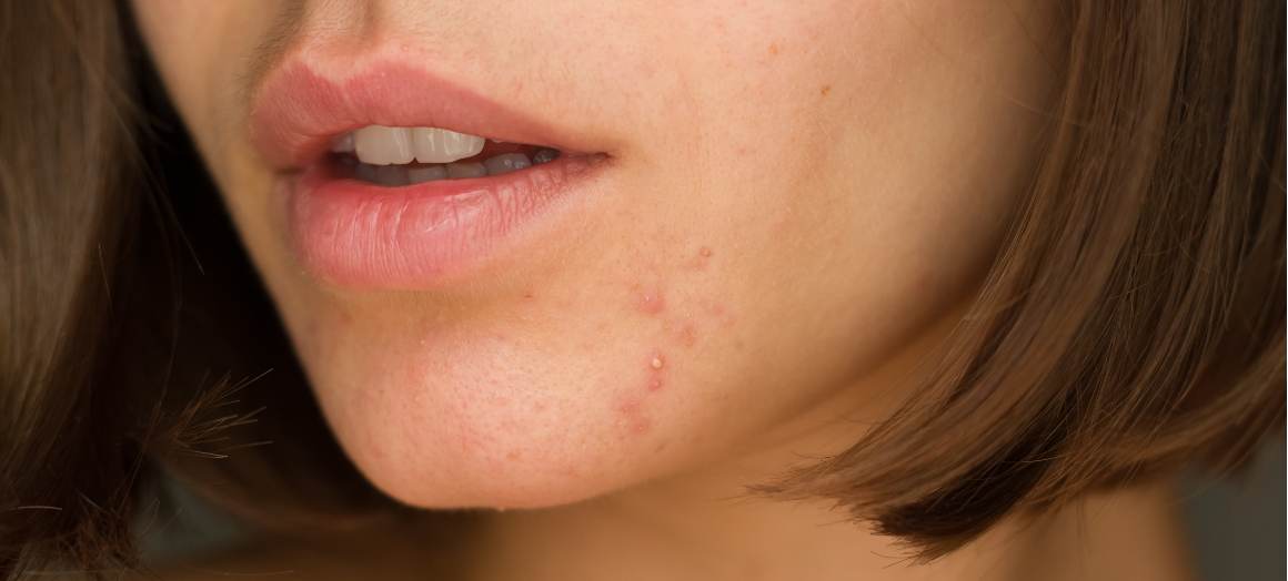 Hur påverkar kosten acne?
