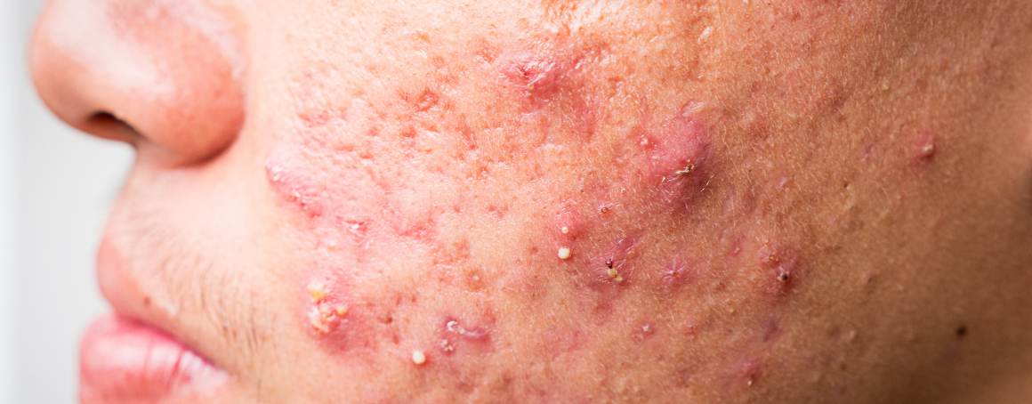 Vilka är de sista stadierna av acne?