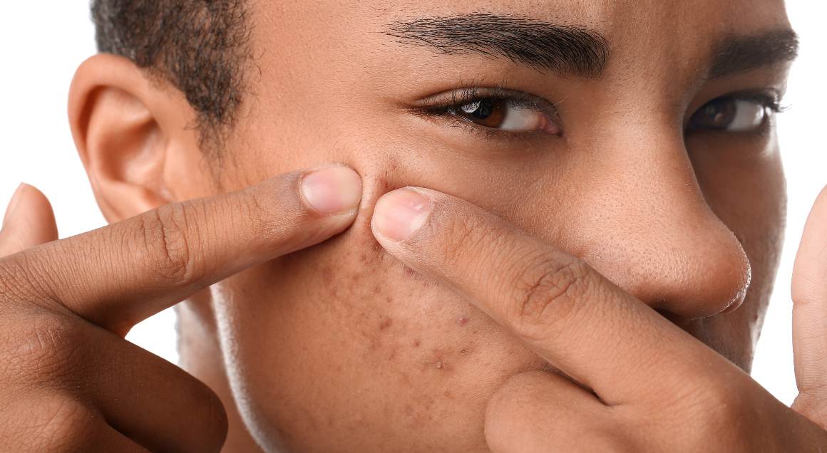Vilka är de 2 vanligaste typerna av acne?