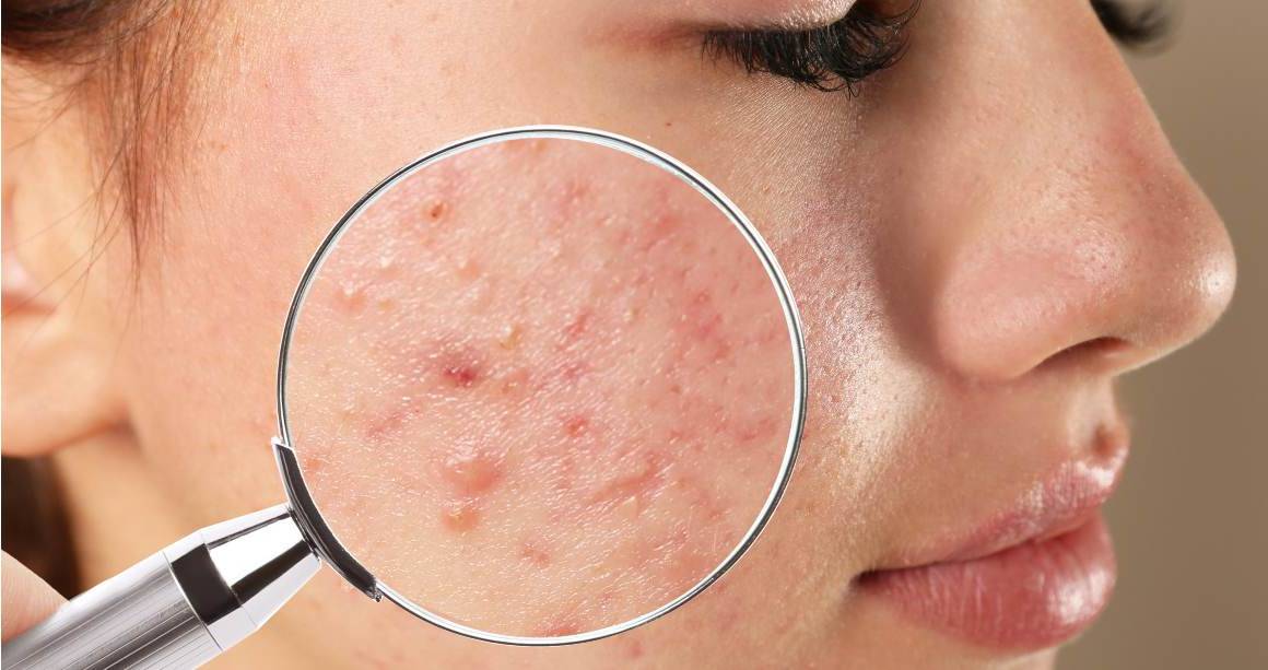 Hur lång tid tar det innan acne försvinner helt?
