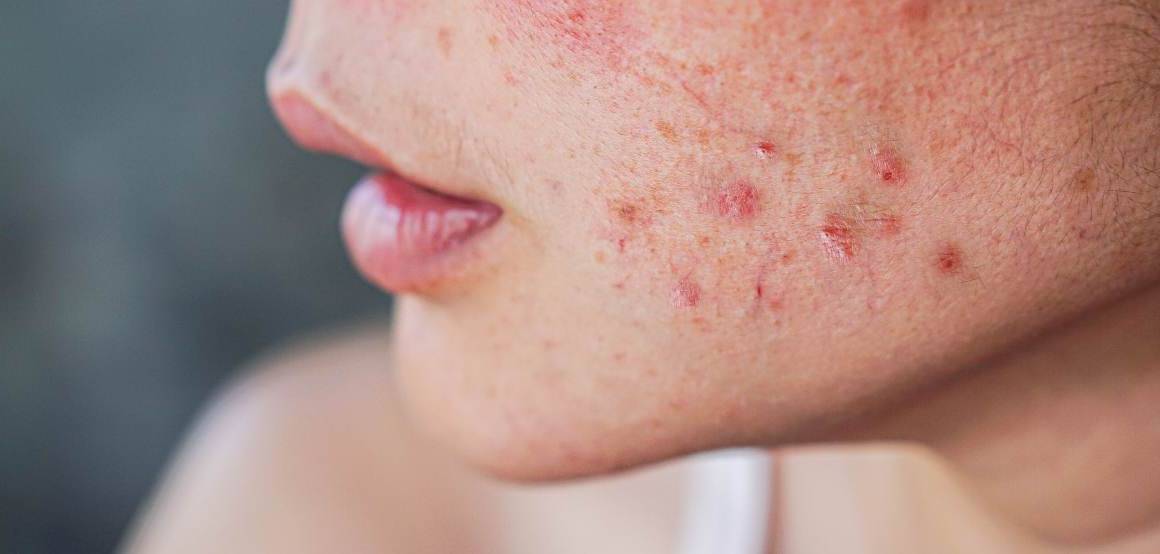 Innebär acne att du åldras långsammare?